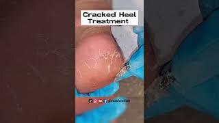 Remove Cracked Heels - So satisfying, 6 mins Cracked heel treatment by miss foot fixer