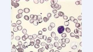 inclusion bodies    pappenheimer bodies