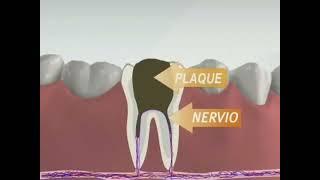 Understanding a Root Canal Procedure