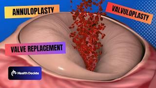 Understand Heart Valve Repair & Replacement: Annuloplasty, Valvuloplasty, and Valve Replacement