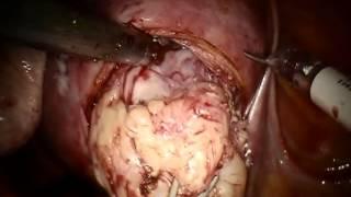 Myomectomy Enucleation Degenerating Fibroid 1 OBG MANAGEMENT