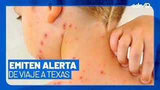 Autoridades sanitarias advierten brote de sarampión en Texas