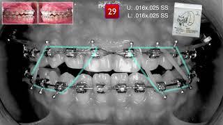 Philosophies in Finishing｜【Chris Chang Ortho】CC491