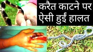 सांप छोड़ते समय हुआ हादसा, देखिये काटा कौनसे करैत ने|snake bite| snake release