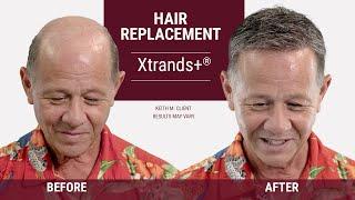 Amazing hair loss solution for men | Hair replacement transformation