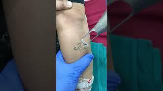 Alat Hapus Tatto Terbaik 2022 #lasertattooremoval