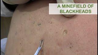 A Minefield of Blackheads | Dr. Derm