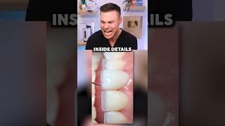 Dentist Reveals What REAL Professional Veneers Look Like! 