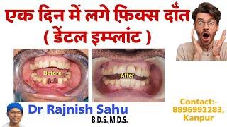 Fixed Teeth Within 1day | Basal Implants | Dental Implants | Part - 1|@rajnishsahu82