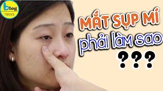 Sụp mi mắt - Nguyên nhân và cách giải quyết hiệu quả