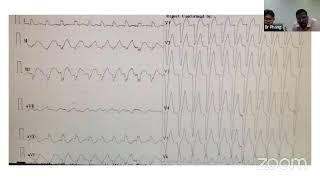 cardiac arrhythmia, when to consult cardiologist, Cardiology, CoPM weekly Webinar - June