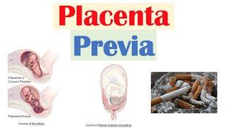 Placenta Previa (Low Lying Placenta) | Risk Factors, Symptoms & Complications, Diagnosis, Treatment