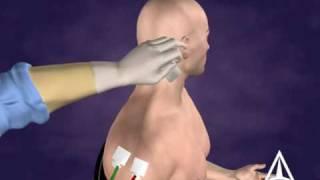 Botulinum Toxin B Injection Technique - 3D Medical Animation