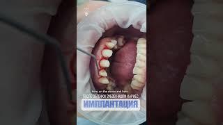 После обточки зубов нашли кариес. After turning the teeth, caries was found.