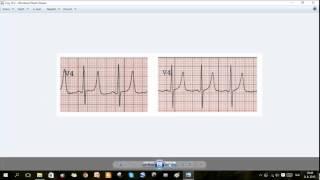 Ekg Podcast 16/56. Zradné T vlny, museli sme resuscitovať. 2. Časť