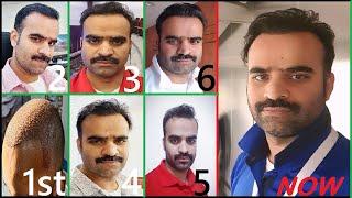 Hair Transplant Results 9 Months Before and After || FUE Hair Transplant In Pakistan || Ahmad Latif