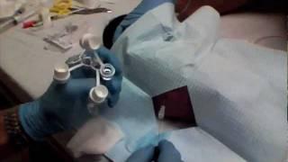 Pediatric Lumbar Puncture- Septic Work Up I