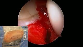 Hip arthroscopy 101 - Interportal capsulotomy