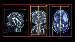 MRI Brain Protocol