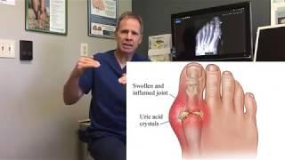 Gout – A Thorough Walkthrough of Treatment Options, Home Remedies, Success Rates