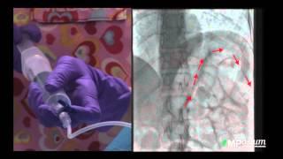 [TEASER] Percutaneous gastrostomy placement under fluoroscopic guidance