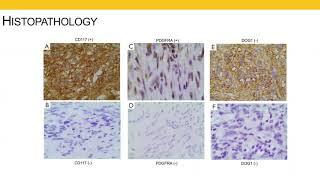 Gastrointestinal Stromal Tumors (GIST)