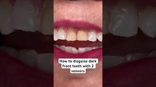 How to disguise discolored front teeth with veneers ️