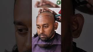 HAIR TRANSPLANT TECHNIQUE That Will Change Your Life!#shorts