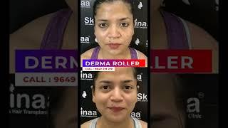 DERMA ROLLER TREATMENT FOR ACNE SCARS | Viral #shorts