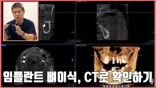 [대전 투명교정, 대전 임플란트] 임플란트 뼈이식, CT로 확인하기