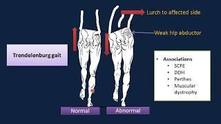 The limping Child and a high yield facts.