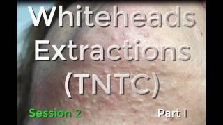 Whiteheads Extraction (TNTC) - Session 2: Part 1 of 3