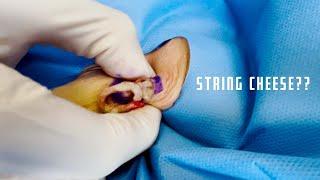 String Cheese or Cyst? | CONTOUR DERMATOLOGY