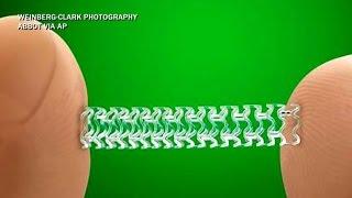 Heart stent can dissolve in patient