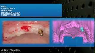 COMPUTER GUIDED  IMPLANTOLOGY AND IMMEDIATE GUIDED LOADING ALL ON FOUR IN ATROPHIC MAXILLA
