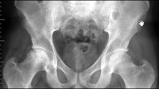 Avascular necrosis (AVN) of hip