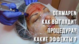 Дермапен (DERMAPEN) как выглядит процедура?