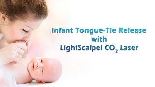 Infant Laser Frenectomy (Tongue-Tie Release) - LightScalpel Laser
