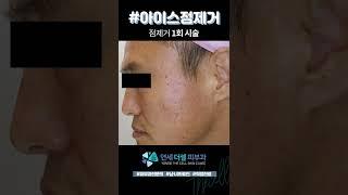 점제거 점빼기 시술 후 5주 경과 전/후 영상  점뺀 후 관리와 효과까지! 지우개로 지우듯 없어지는 점! #아이스점제거 #점제거#shorts