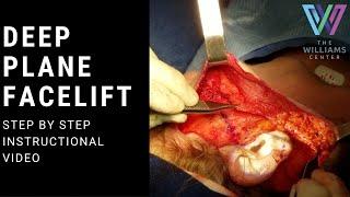 Performing a Deep Plane Facelift: Surgical Instructions