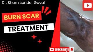 Agra Burn Scar Combination Treatment | Science Behind | Old Burn Scar | Kayakalp Laser Clinic