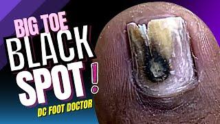 Big Toe Black Spot