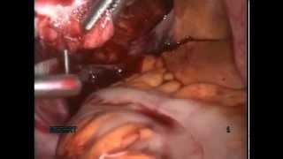 Laparoscopic myomectomy with enclosed transvaginal tissue extraction