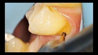 Filling a Cavity: Can Gumline Decay be Fixed with Tooth Colored Fillings?