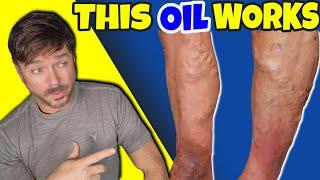 Ancient Oil Shrinks Varicose Veins Naturally! | Chris Gibson