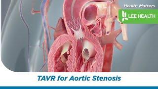 TAVR for Aortic Stenosis