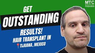 Hair Transplant Surgery in Mexico: From Day 1 to the 6-Month Milestone!