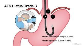 GERD - Endoscopic Evaluation - Assessment of anti-reflux mechanism