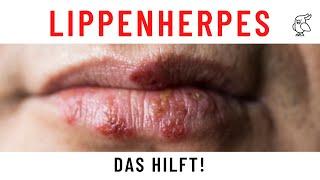 GEFAHRENFAKTOR LIPPENHERPES Was hilft und wann zum Arzt? Lippenherpes schnell weg bekommen!