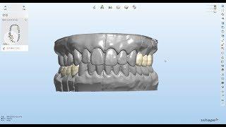 How to design? CAD/CAM Crown & Bridge(3unit)